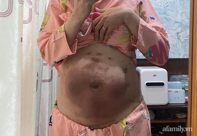 Mẹ bầu bị dị ứng thai kỳ gây chàm bội nhiễm, chỉ biết khóc vì đau đớn, tự ti lẫn tủi thân bao trùm-2