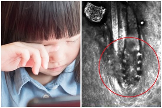 Con gái 10 tuổi bứt trụi lông mi vì khó chịu, cận cảnh đôi mắt đứa trẻ gây ớn lạnh, bác sĩ nhắc nhở một việc khiến phụ huynh giật mình