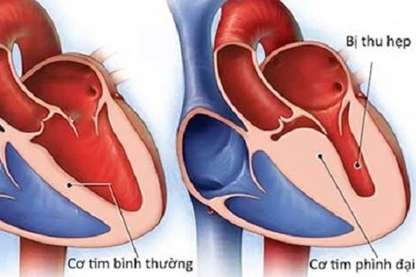 Viêm cơ tim sau tiêm vaccine COVID- 19 có đáng ngại?-1