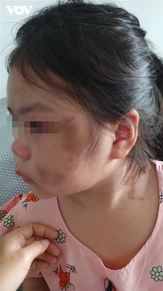 Bé gái 6 tuổi ở Bình Dương bầm tím mặt vì cha lỡ tay khi dạy học-1