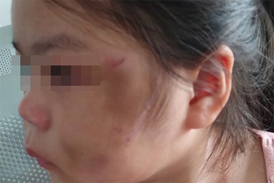 Bé gái 6 tuổi ở Bình Dương bầm tím mặt vì cha “lỡ tay khi dạy học
