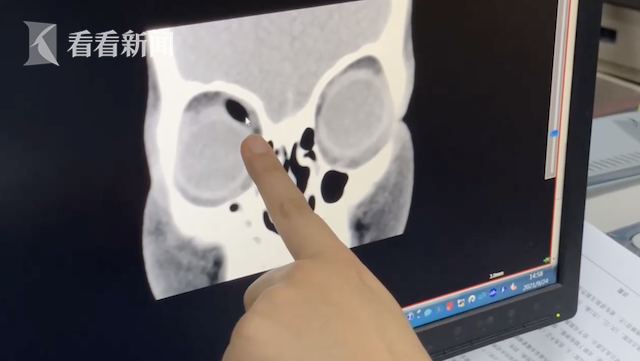 Bé gái 3 tuổi vừa ăn xong chạy ra ngoài thì bị ngã, nhìn thấy thứ con cầm trên tay, mẹ kinh hoàng vội đưa ngay đến bệnh viện-2