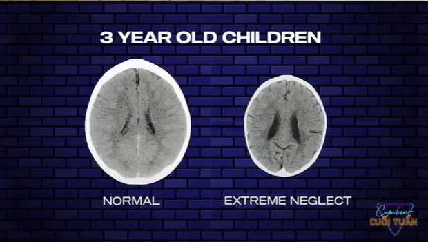 Ảnh chụp bên trong não đứa trẻ 3 tuổi được khen và một đứa hay bị la mắng, đánh đập... khiến cha mẹ giật mình-1