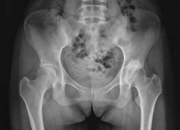 Cô gái bị đau lưng không ngủ được, khám thấy xương thủng như tổ ong, tất cả là do 1 loại nước nhiều người yêu thích-1