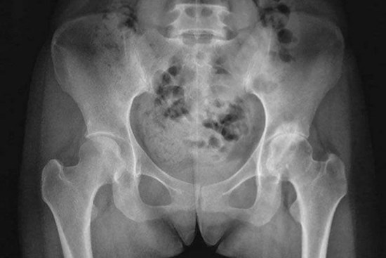 Cô gái bị đau lưng không ngủ được, khám thấy xương