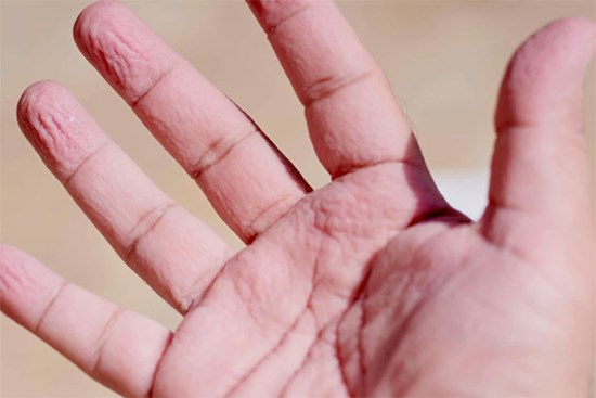 Các triệu chứng lạ mới phát hiện ở bệnh nhân Covid-19