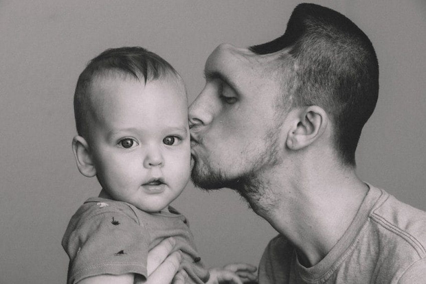 Ông bố trẻ đột ngột phải cắt bỏ nửa bộ não, lý do bắt nguồn từ một sai lầm đơn giản nhiều người mắc phải-2