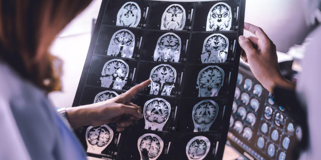 Ngay cả những trường hợp mắc COVID-19 thể nhẹ cũng để lại những ảnh hưởng lâu dài trên não bộ-1