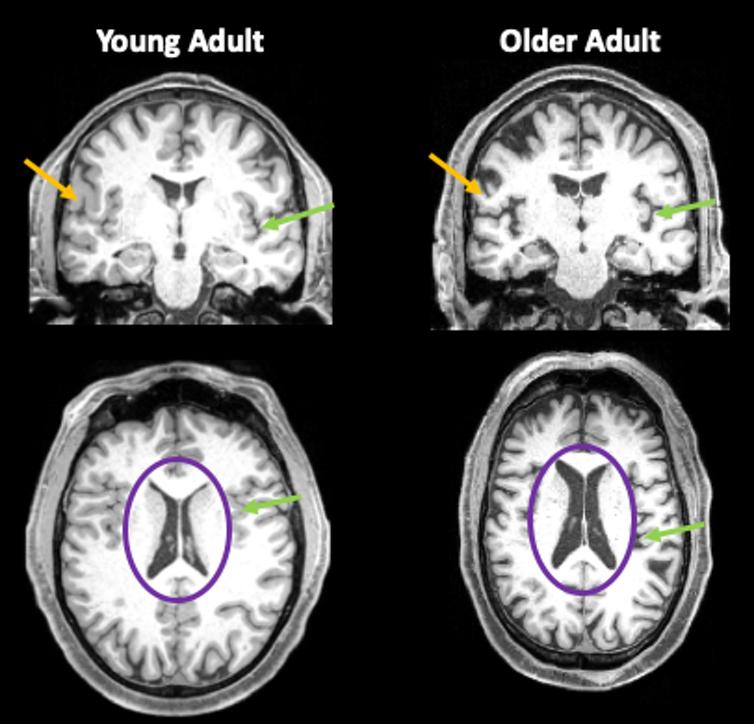 Ngay cả những trường hợp mắc COVID-19 thể nhẹ cũng để lại những ảnh hưởng lâu dài trên não bộ-4