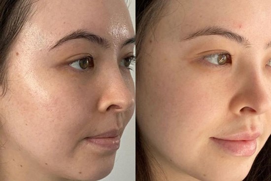 Vitamin C cho da nhạy cảm: Nhớ 5 điều này thì làn da thâm nám sẽ 
