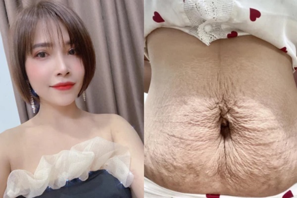 Vợ mặc cảm, tự ti vì vòng 2 xấu xí sau sinh, chồng phát biểu 1 câu khiến ai cũng thấy mát lòng thay đúng là chồng người ta-1