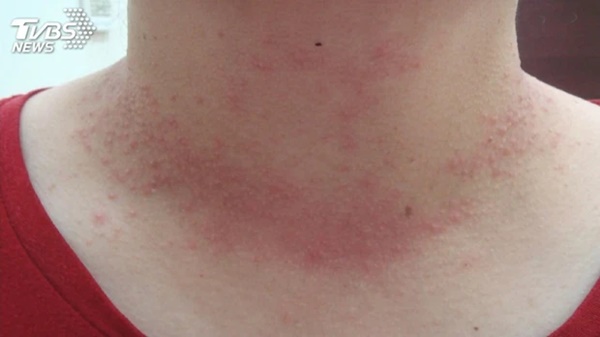 3 ngứa trên cơ thể cảnh báo tế bào ung thư gan đang manh nha xuất hiện-2