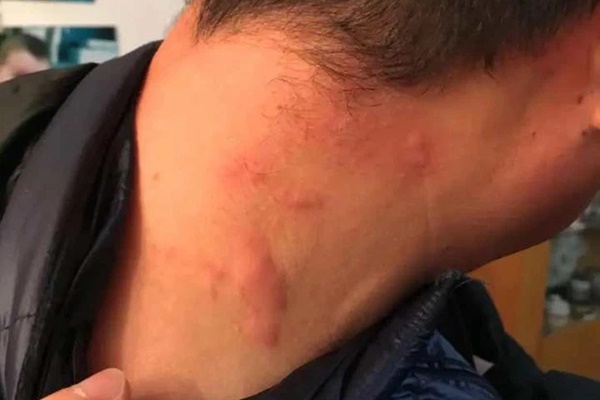 Người đàn ông phải cắt bỏ hậu môn do ung thư trực tràng, nguyên nhân xuất phát từ thói quen sinh hoạt xấu mà nhiều người trẻ mắc phải-5