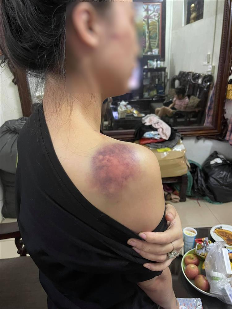 Nóng: Vợ 9X bị chồng bạo hành xuyên đêm, dùng cả gậy sắt đánh tới biến dạng khuôn mặt-2