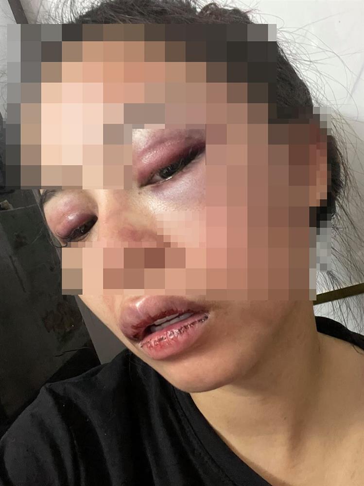 Nóng: Vợ 9X bị chồng bạo hành xuyên đêm, dùng cả gậy sắt đánh tới biến dạng khuôn mặt-4