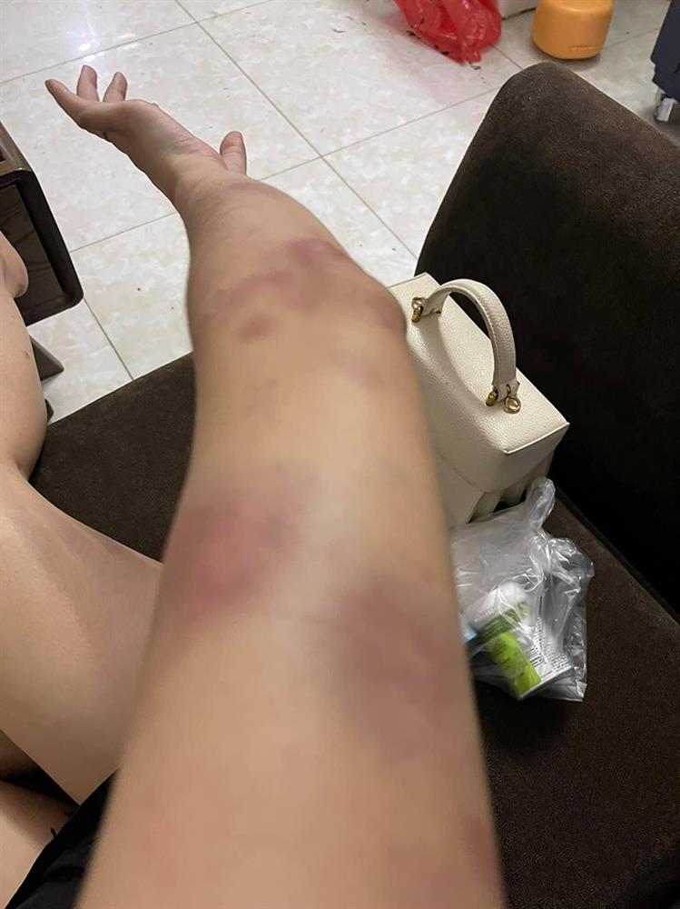 Nóng: Vợ 9X bị chồng bạo hành xuyên đêm, dùng cả gậy sắt đánh tới biến dạng khuôn mặt-5