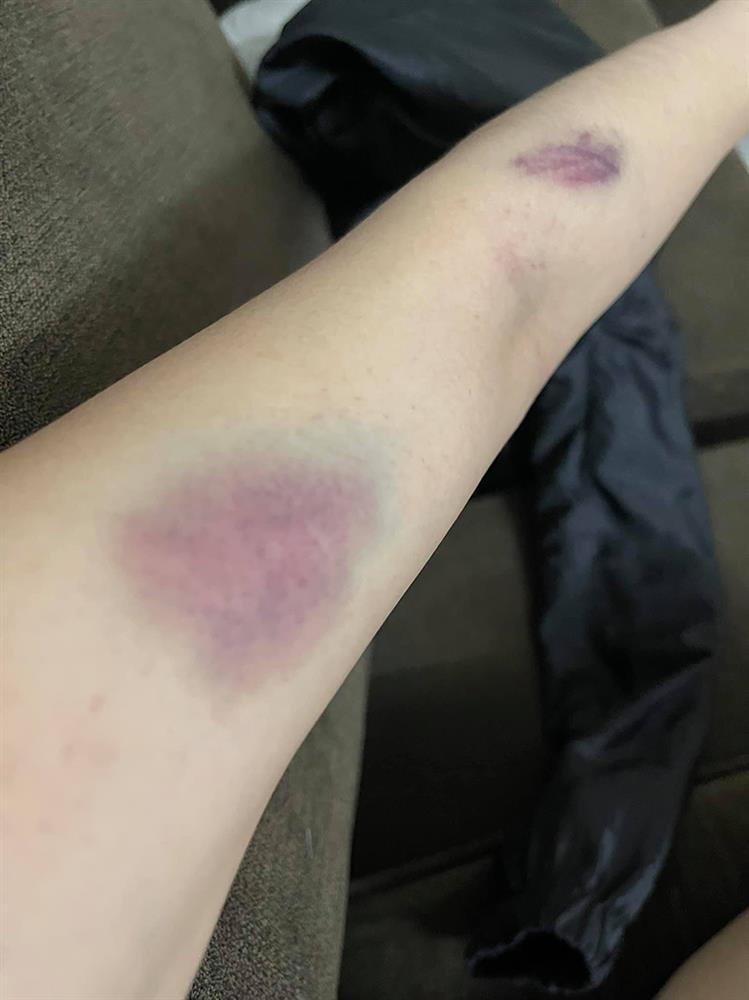 Nóng: Vợ 9X bị chồng bạo hành xuyên đêm, dùng cả gậy sắt đánh tới biến dạng khuôn mặt-8
