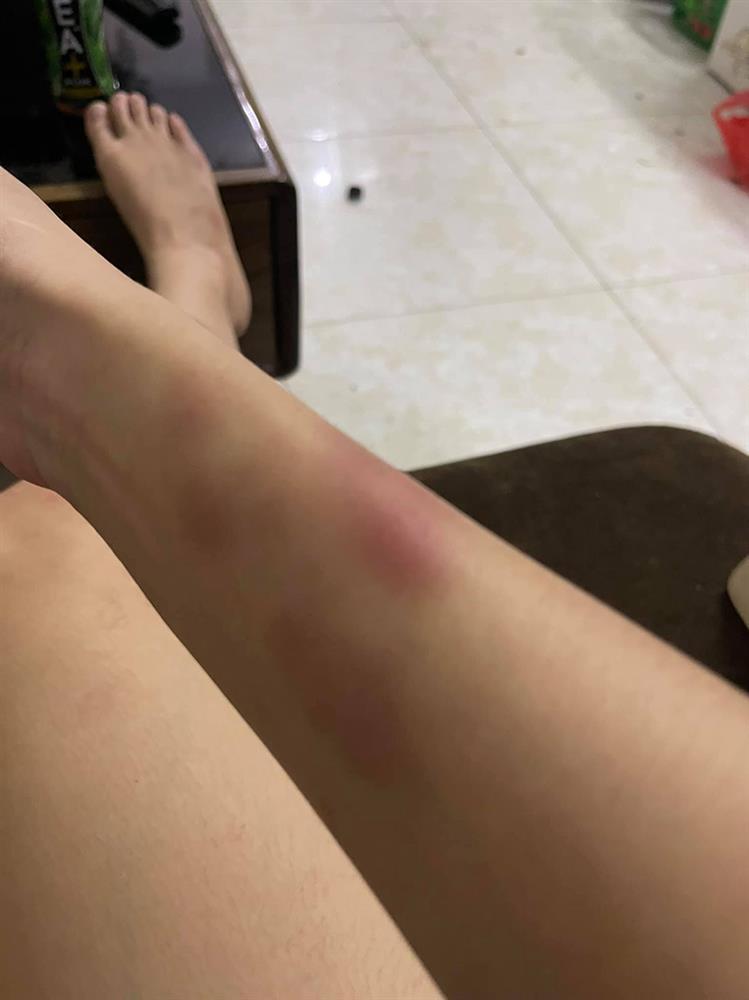 Nóng: Vợ 9X bị chồng bạo hành xuyên đêm, dùng cả gậy sắt đánh tới biến dạng khuôn mặt-9