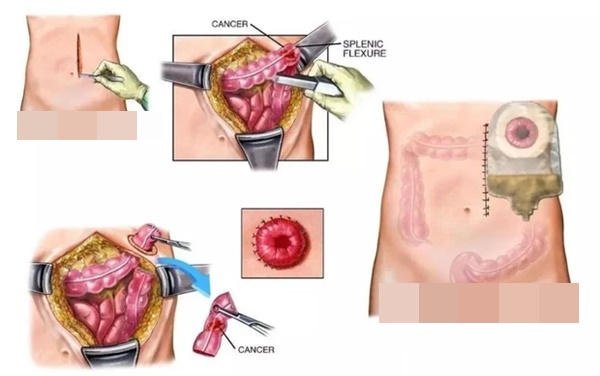 Người đàn ông phải cắt bỏ hậu môn do ung thư trực tràng, nguyên nhân xuất phát từ thói quen sinh hoạt xấu mà nhiều người trẻ mắc phải-3