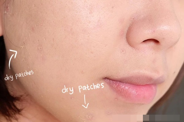 SỰ THẬT: Retinol có thể gây kích ứng gấp đôi vào mùa hanh khô?-1