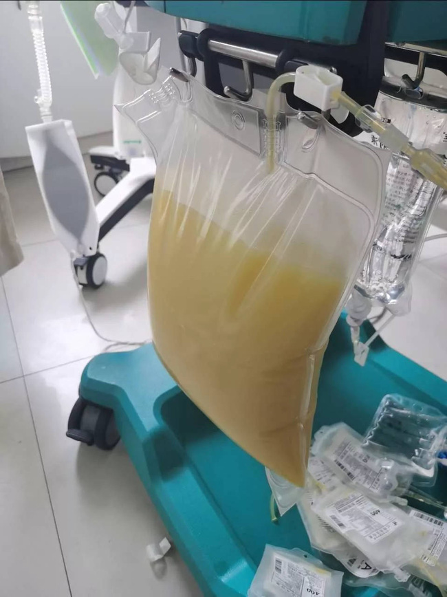 Ăn quá nhiều chân giò hầm, người phụ nữ đang mang thai 28 tuần tuổi nhập viện trong tình trạng nguy kịch, nhìn lượng mỡ tách ra từ máu gây sốc-2