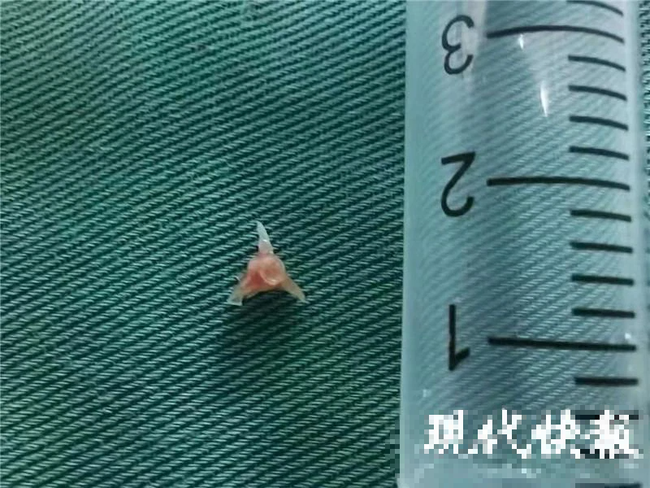 Con trai 2 tuổi ho khò khè mãi không hết, nửa năm sau bác sĩ lôi ra một thứ từ phế quản đứa trẻ mà gia đình sốc nặng-2