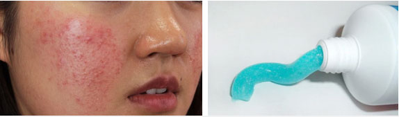 Dùng kem đánh răng trị mụn là sai lầm kinh khủng nhất quả đất!-2