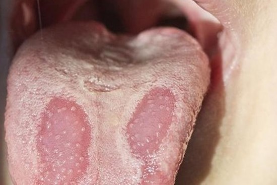 3 tín hiệu kỳ lạ trên lưỡi cho thấy đường huyết của bạn tăng cao quá mức, cần ăn nhiều 4 món để tránh các biến chứng đáng sợ