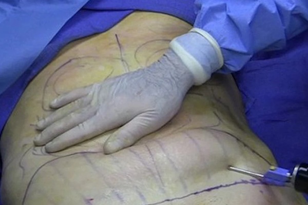 Từ vụ người phụ nữ tử vong sau hút mỡ bụng ở TP HCM: Chuyên gia khuyến cáo những điều cần lưu ý khi phẫu thuật thẩm mỹ-1