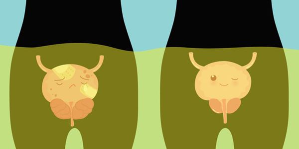 Tế bào ung thư xuất hiện ở tuyến tiền liệt sẽ khiến bạn gặp 4 điều bất thường khi đi tiểu, nếu có nhiều hơn 2 thì nên đi khám ngay-1