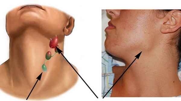 Hạch sưng to trên cổ nếu đi kèm với 4 hiện tượng bất thường thì nên đi khám càng sớm càng tốt-1