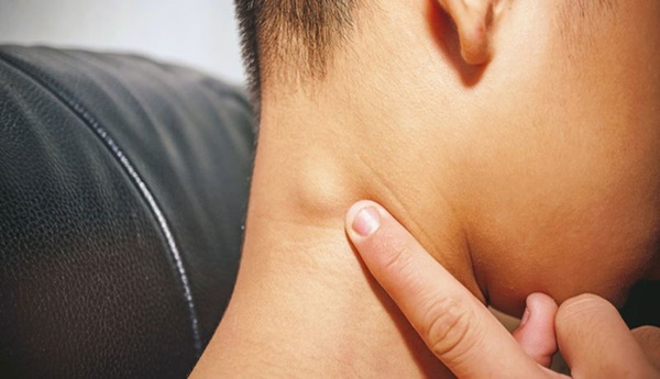 Hạch sưng to trên cổ nếu đi kèm với 4 hiện tượng bất thường thì nên đi khám càng sớm càng tốt-4