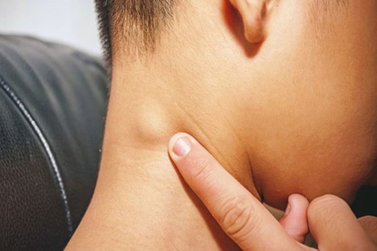 Hạch sưng to trên cổ nếu đi kèm với 4 hiện tượng bất thường thì nên đi khám càng sớm càng tốt