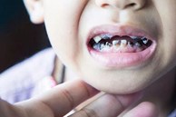 Quan niệm “ăn kẹo gây sâu răng” lẽ ra phải thay đổi từ lâu! Bé bị sâu răng vì làm sai 3 điều này