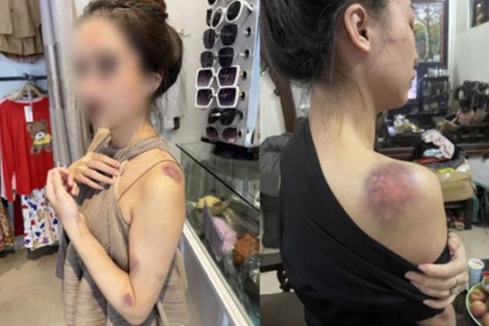 Bị tố tra tấn vợ 