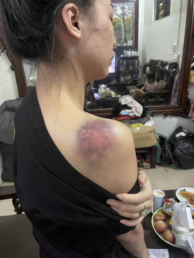Bị tố bạo hành vợ xuyên đêm ở Yên Bái, người chồng lên tiếng: Có tát, đấm vào đầu và vai nhưng không nhốt, đánh bằng gậy sắt-2