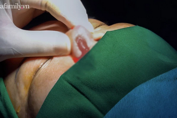 Cắt mí thành đôi mắt quỷ, cô gái trẻ bị cho thôi việc-4