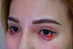Cắt mí mắt ở cơ sở thẩm mỹ chui, một phụ nữ bị hỏng mắt-2