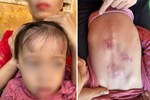 Vụ bé gái 2 tuổi bị bạn học đánh đạp dã man: Trường mầm non cũng từng bị tố để học sinh bị cắn bầm tím khắp mặt và đùi-2