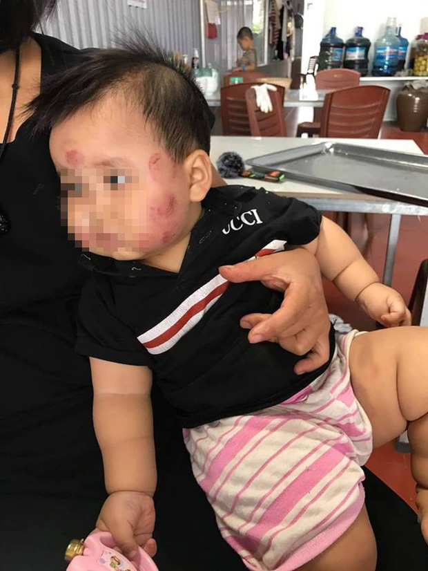 Vụ bé gái 2 tuổi bị bạn học đánh đạp dã man: Trường mầm non cũng từng bị tố để học sinh bị cắn bầm tím khắp mặt và đùi-1