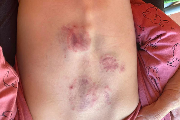 Vụ bé gái 2 tuổi bị bạn học đánh đạp dã man: Tạm đình chỉ hoạt động nhóm trẻ mầm non Vân Vũ cho trẻ 2,3,4 tuổi ở lẫn lộn-2