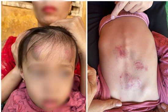 Vụ bé gái 2 tuổi bị bạn học đánh đạp dã man: Tạm đình chỉ hoạt động nhóm trẻ mầm non Vân Vũ cho trẻ 2,3,4 tuổi ở lẫn lộn
