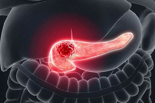 Người phụ nữ 30 tuổi phát hiện mắc ung thư trực tràng giai đoạn cuối vì thường xuyên ăn loại thịt nhiều người vô cùng yêu thích-3