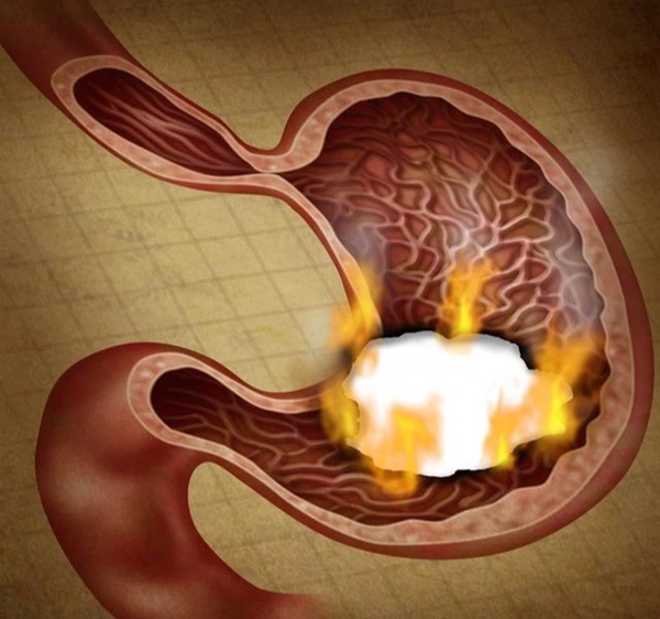 Vi khuẩn HP sẽ bị giết chết nếu bạn tiêu thụ 2 món rẻ bèo này mỗi ngày, cứ chăm ăn thì cả đời không lo mắc ung thư dạ dày-1