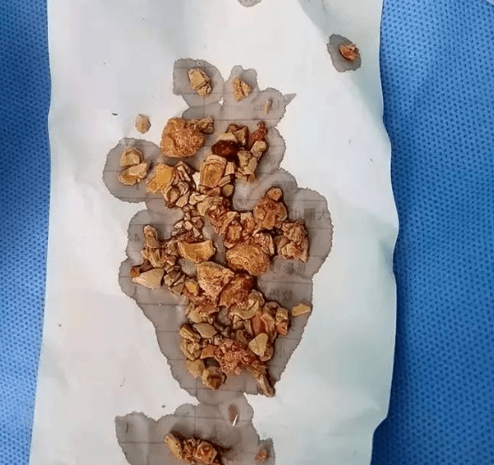 Hai bên thận của bé gái 5 tháng tuổi toàn sỏi, nguyên nhân xuất phát từ việc làm mà nhiều cha mẹ hay mắc phải-2