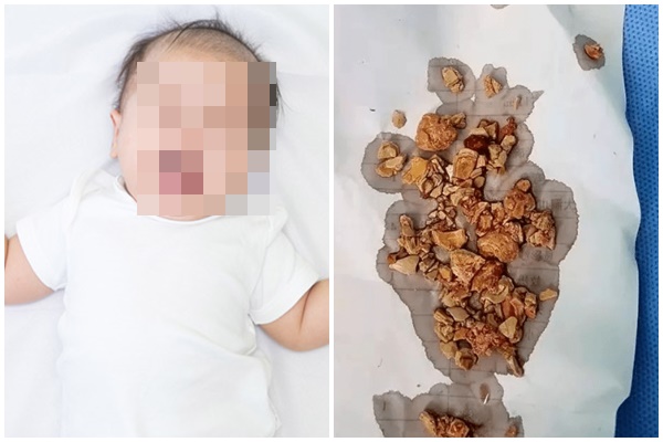 Thói quen tưởng vô hại nhưng lại là nguyên nhân khiến thận chứa cả túi sỏi-3