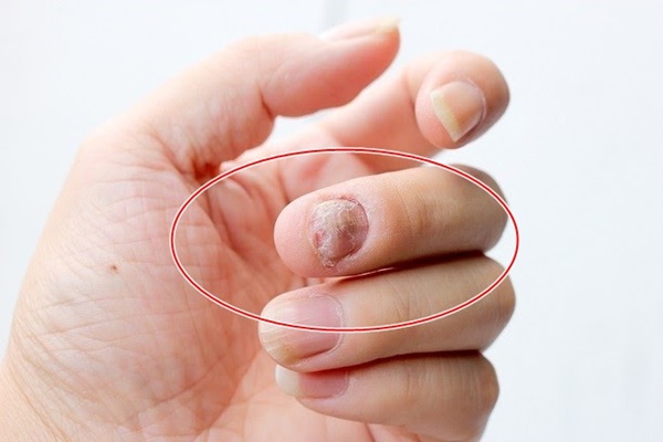 4 thay đổi trên bàn tay cho thấy lá gan của bạn đang cầu cứu, phát hiện sớm có thể điều trị hiệu quả-2