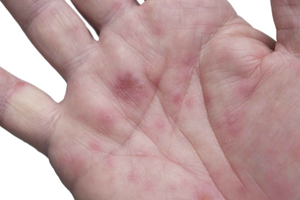 4 thay đổi trên bàn tay cho thấy lá gan của bạn đang cầu cứu, phát hiện sớm có thể điều trị hiệu quả-3
