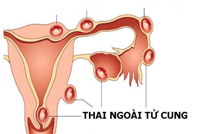 Mang thai ngoài tử cung đừng đổ lỗi cho phụ nữ, mà nguyên nhân có thể do nam giới gây ra-1