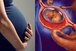 Bệnh phụ nữ mang thai rất hay gặp nhưng dễ bị bỏ qua, có thể nguy hiểm đến tính mạng-2